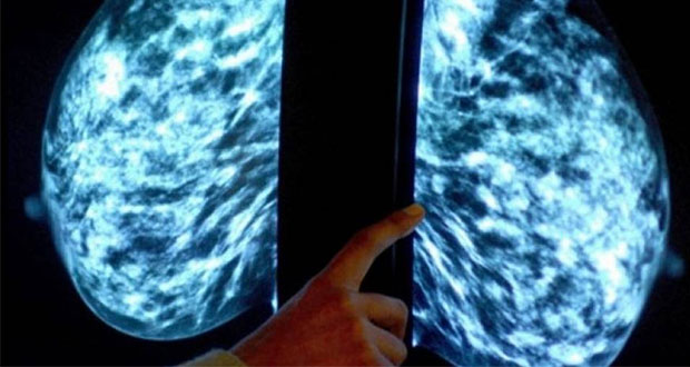 Hallan diana terapéutica para cáncer de mama más agresivo. Foto: El nuevo herald
