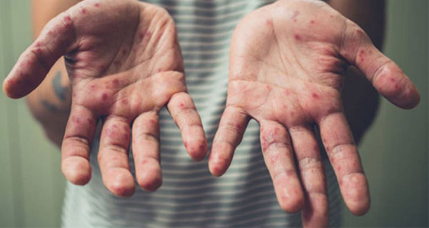 Sube a 41 mil contagios y 37 muertes por sarampión en Europa: OMS