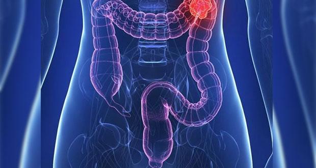 Al año se diagnostican 4 mil 500 casos de cáncer testicular en México