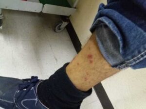 Acusan usuarios que camas del IMSS Metepec están infestadas de chinches