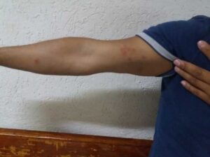 Acusan usuarios que camas del IMSS Metepec están infestadas de chinches
