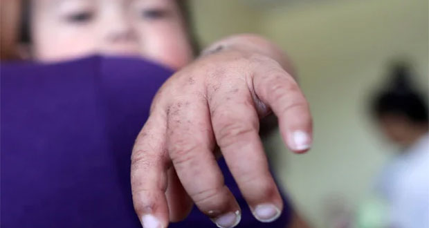 Se triplican casos de Sarampión en el mundo, advierte OMS