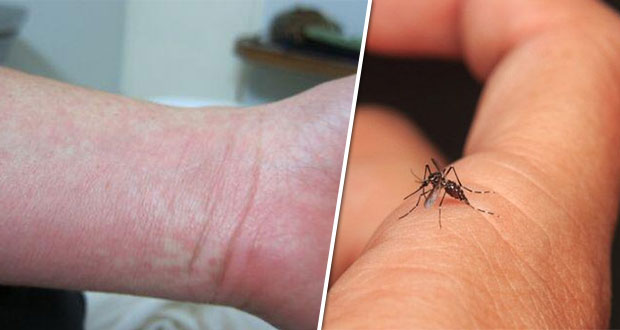 Salud reporta 43 casos de dengue en Puebla; Acatlán, el más afectado