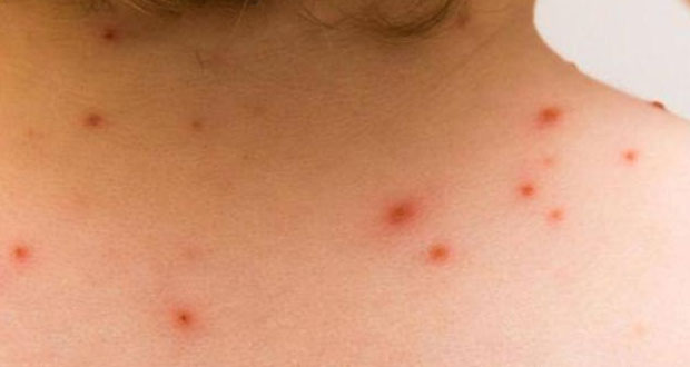 Van 35 casos de viruela del mono en México; 94%, en hombres