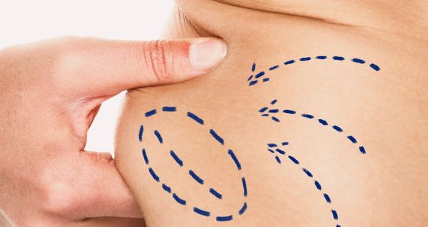 El abdomen que deseas es posible con cirugía plástica en Puebla