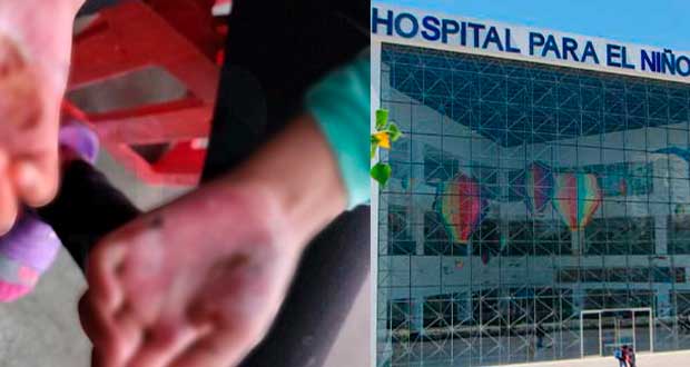 Hospitalizan a menor quemada por su padre en Amozoc; DIF lo denuncia   
