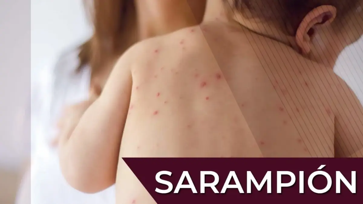 Salud emite aviso epidemiológico por 859 posibles casos de sarampión