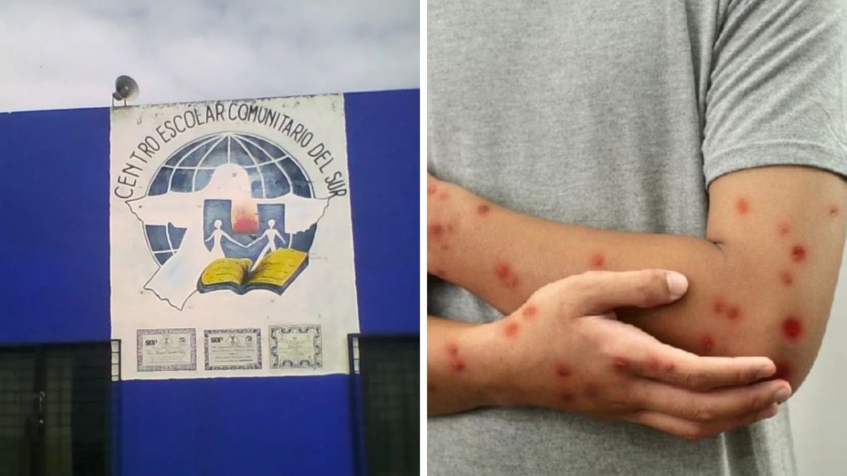Activan protocolo sanitario por caso de sarampión en Centro Escolar del Sur de Puebla